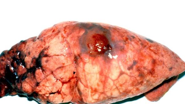 Chonic App lesion in the diaphragmatic lobe with pleuritc tags