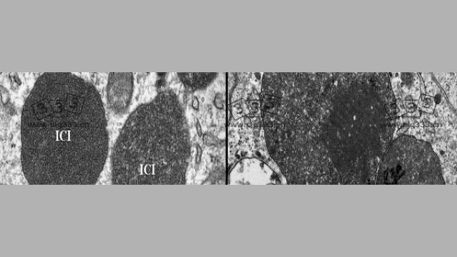 Electron micrograph of a lymph node from a PCV2-SD affected pig