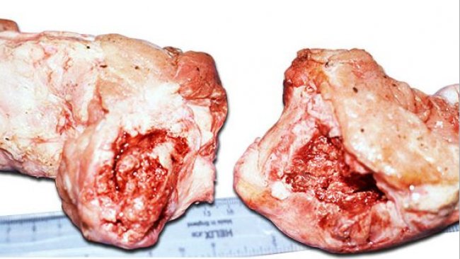 Entire head of the femur fractured at or below the epiphysis showing swelling around fracture site due to periostitis