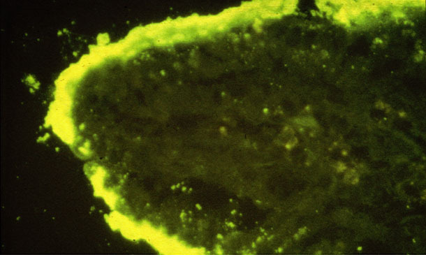attachment of dense colonies of E coli on an intestinal villus (IFA)