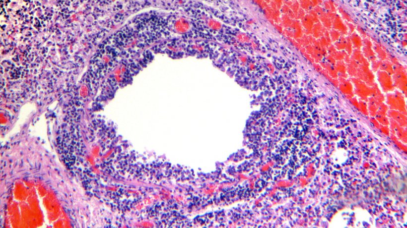 Figure 4. Bronchiole showing desquamation and necrosis of the respiratory epithelium, along with marked lymphocytic infiltration of the lamina propia and submucosa.
