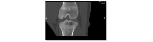 同一病变的计算机断层扫描图。严重的骨软骨病病变，股骨外侧髁下关节区缺乏骨化。
