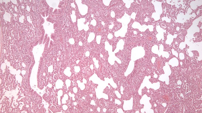 图2:PRRSV感染的间质性肺炎，特征是肺泡壁增厚。