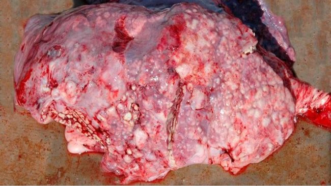 图5:化脓杆菌引起的栓塞性肺炎。