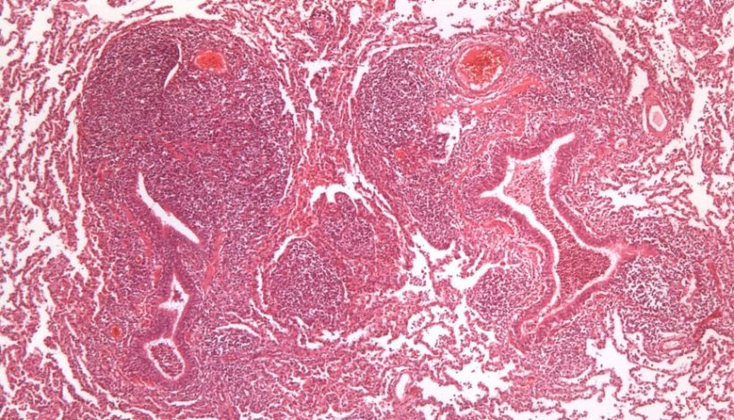 图2：猪肺炎支原体引起的细支气管周围淋巴组织增生。