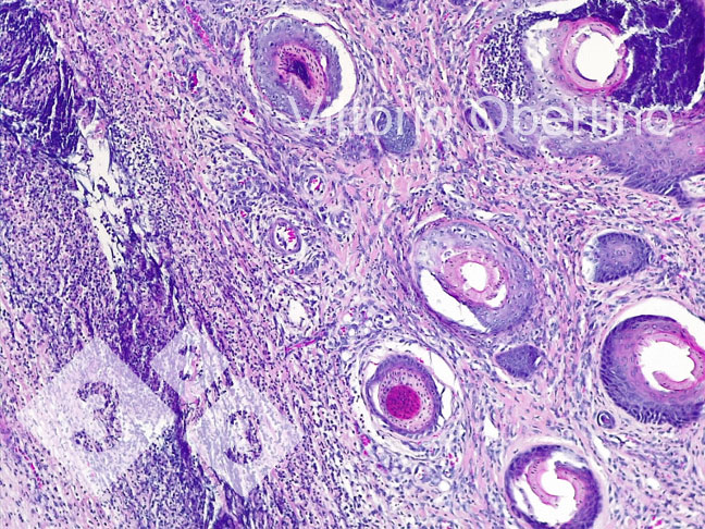 图8：肚脐。局部广泛的真皮区域，包括纤维增生和活化的成纤维细胞和许多未成熟的小血管（新形成的肉芽组织），多灶性炎性浸润，以淋巴浆细胞为主；在一些血管结构中，血管壁周围有粒细胞炎性浸润，并局部浸润（白细胞破坏性血管炎）。