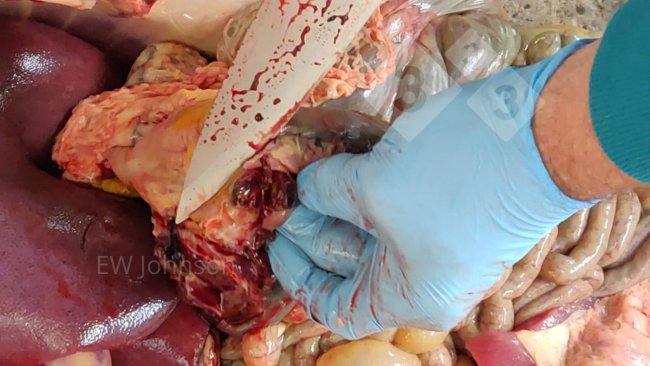 图2:胃肝淋巴结出血坏死.