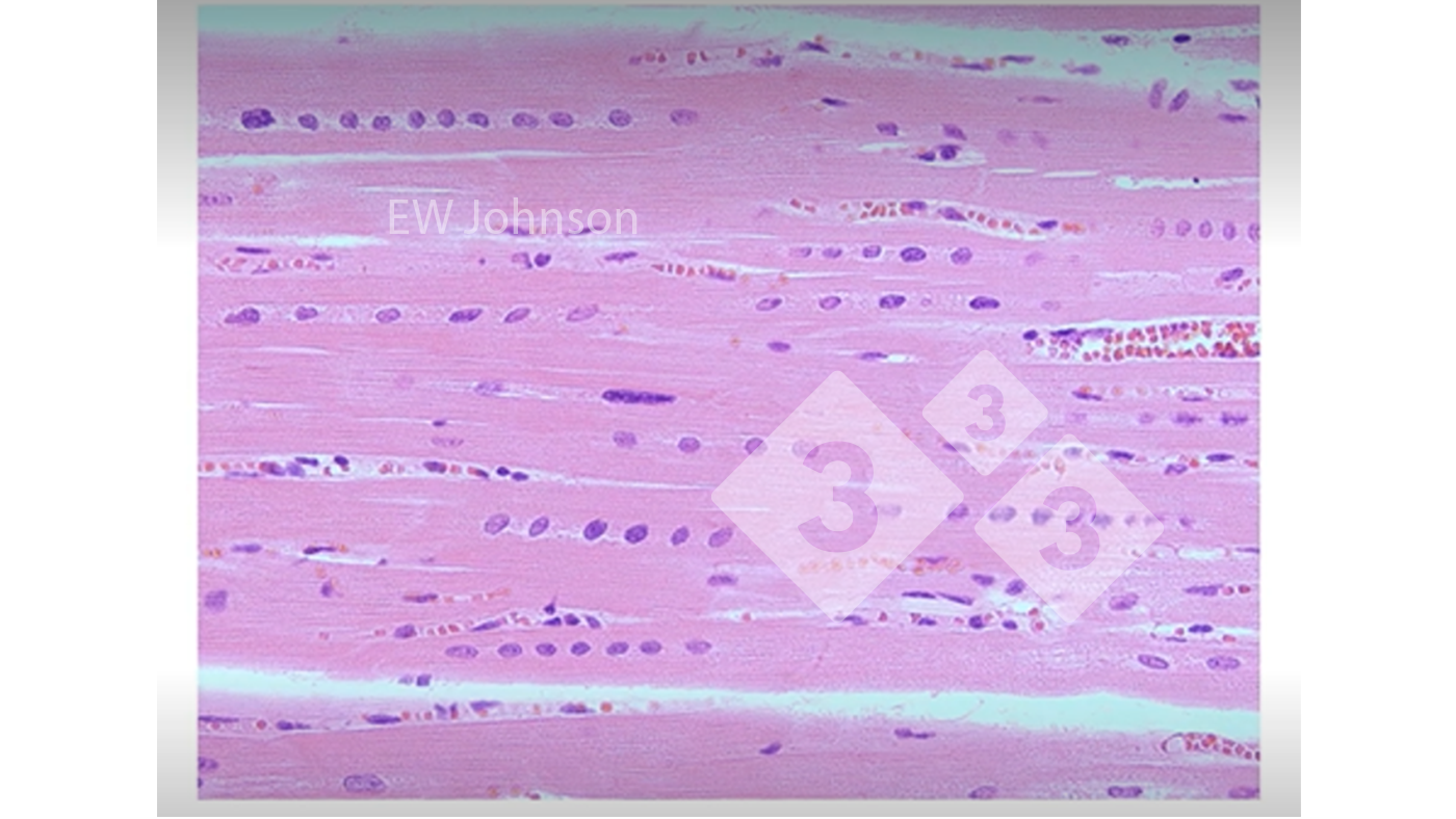 Figure 3: Heart muscle with haemorrhage, hyaline necrosis, and rowing of the nucleus showing vitamin E and selenium deficiency. These pigs would not have a normally functioning immune system.
