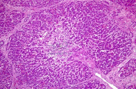 肝中心小叶坏死和肝脏结构大量受损，并可见单核细胞炎症和巨红细胞